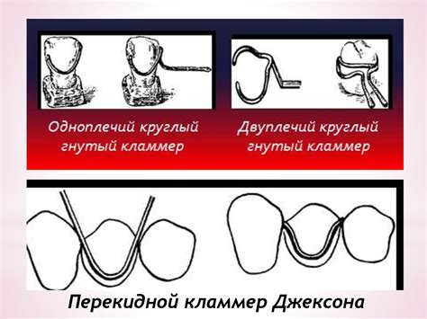 Кламмерная система - презентация онлайн