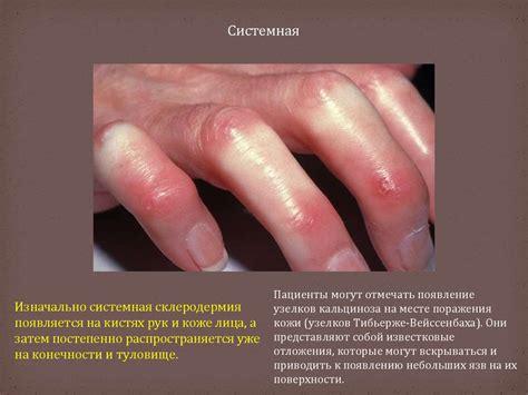 Диффузные заболевания соединительной ткани - online presentation