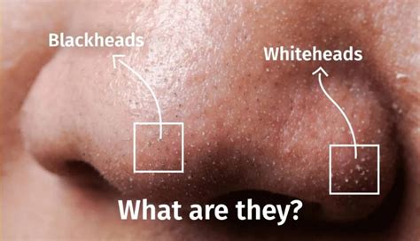 whiteheads     rid