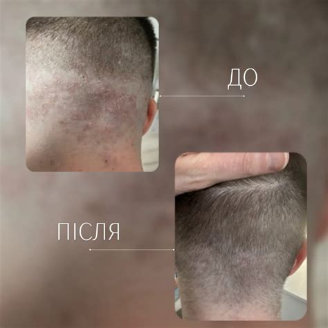 Лікування волосся | Лікар трихолог📍Одеса | Псоріаз волосистої частини ...