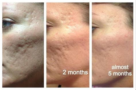 Acne Scar Treatment Near Me - NEARSF