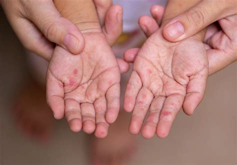 Hand, Foot, And Mouth Disease In Adults: Symptoms And, 53% OFF