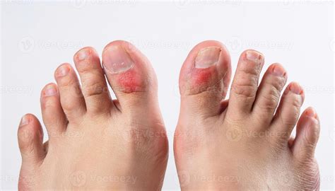 close-up of chilblains on toes with swollen, red, and itchy skin