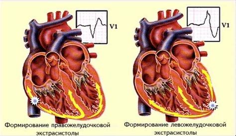 Что такое экстрасистолы и как от них избавиться? | LS