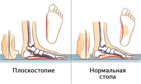 Как подобрать ортопедические стельки для ребенка - kalynka.com.ua
