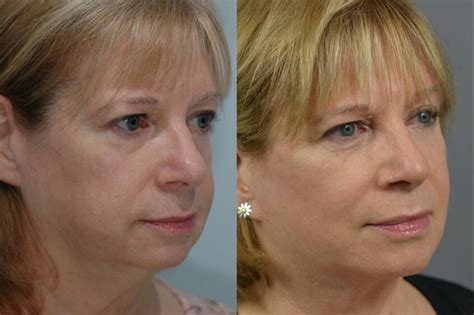 Facial Rejuvenation Before & After Patient 13 | Dr. Marotta