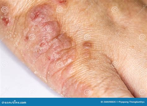 Background of Human Skin with Dust Mite Allergy. Stock Image - Image of ...