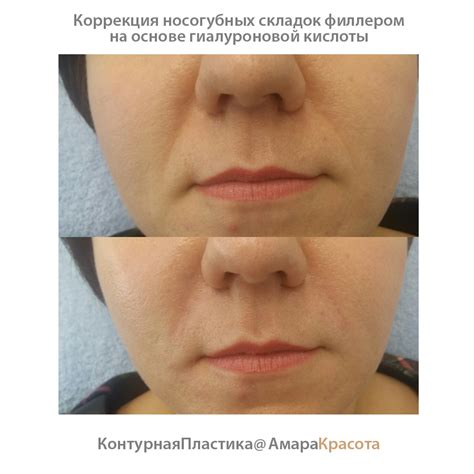 Гуаша Отзывы До И После Фото — Картинки фотографии