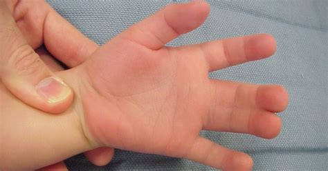 Conditions Associated With Webbed Hands & Feet - HealthPrep.com