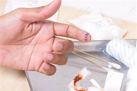 Wound On Finger Scar Surgery Medicine Photo Background And Picture For ...