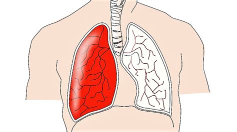 Enfisema | Qué es, tipos, síntomas, diangóstico, tratamiento | Enfermedad