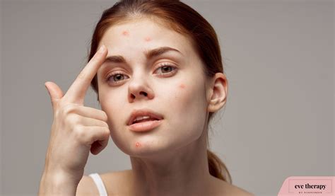 mastering acne management strategies  clear  radiant skin eve