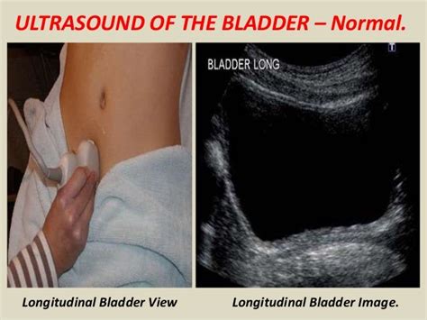 Presentation1.pptx, ultrasound examination of the urinary bladder and…