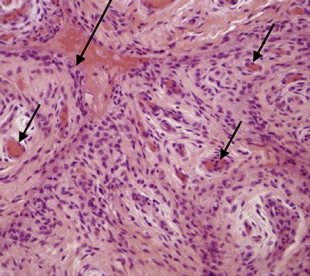 Propionibacterium acnes contamination in shoulder surgery