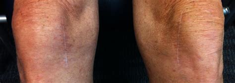 NYC Robotic Partial Knee Replacement | Mako Knee Surgery | UES