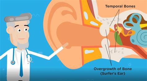 What Is Surfers Ear Infection? | KiteKahunas Surfers Ear Medical