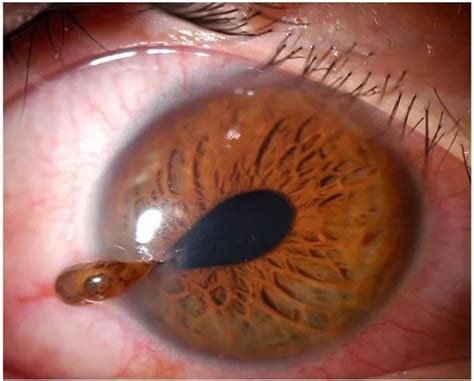 Ruptured Globe Peaked Pupil