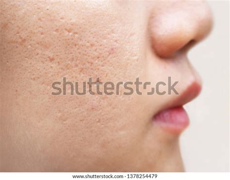 3,713 Acne Scars Skin Isolated Images, Stock Photos & Vectors ...