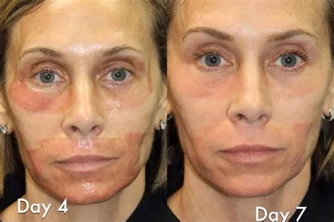Laser Resurfacing Archives - Cosmetic Dermatology | Miami, FL
