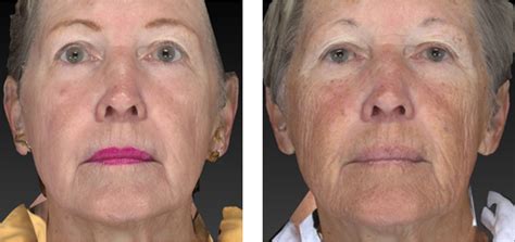 Wrinkle Reduction The Villages | Village Institute of Plastic Surgery