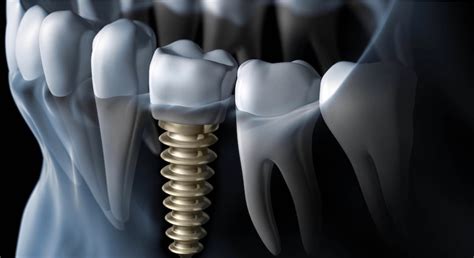 Causes-of-Dental-Implant-Failure - VDSC