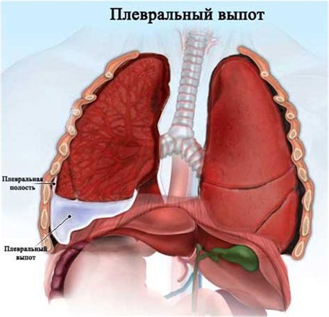 Как лечить осумкованный плеврит