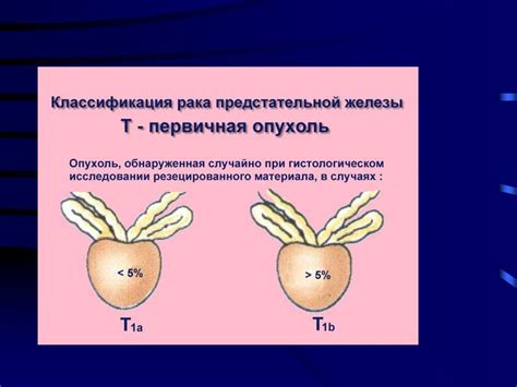 Рак предстательной железы - презентация онлайн