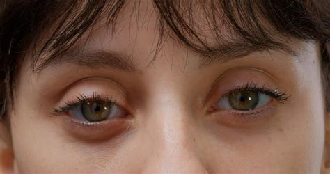 Ptosis Ibu Hamil, Bagaimana Cara Mengatasinya