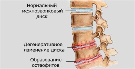 Остеохондроз шейного отдела позвоночника – причины, симптомы и лечение