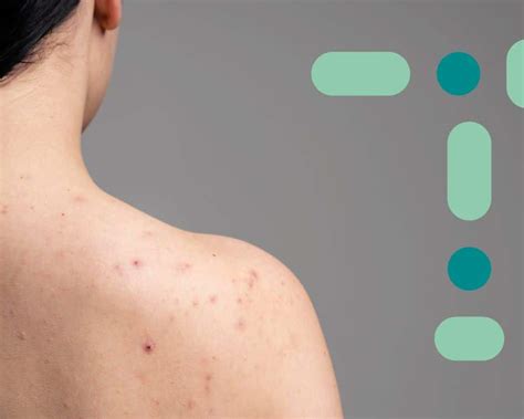 Espinhas No Colo O Que Significa - Qual o motivo das espinhas pelo corpo? Entenda!