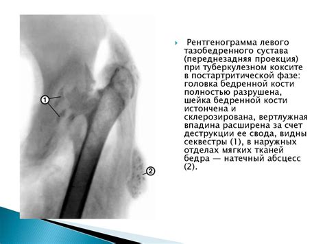 Туберкулез костей и суставов - презентация онлайн