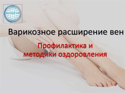 Варикозное расширение вен. Профилактика и методики оздоровления ...
