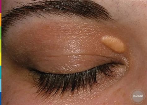 DERMAQUEST » Ксантелазмы| Статьи | Отзывы | Купить