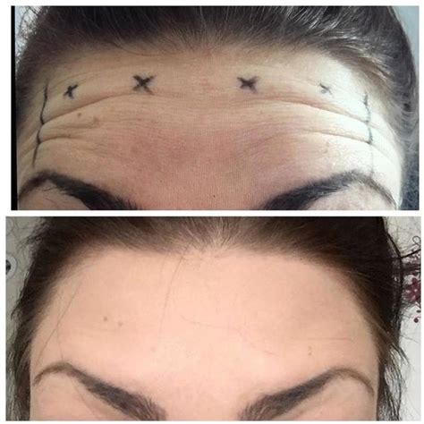 Forehead Botox Injections