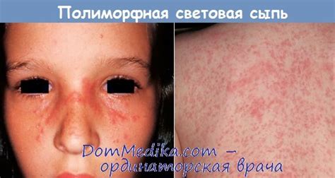 Полиморфная световая сыпь - диагностика, лечение