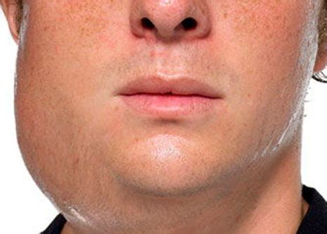Inflamação das glândulas salivares (parótida, submandibular e ...