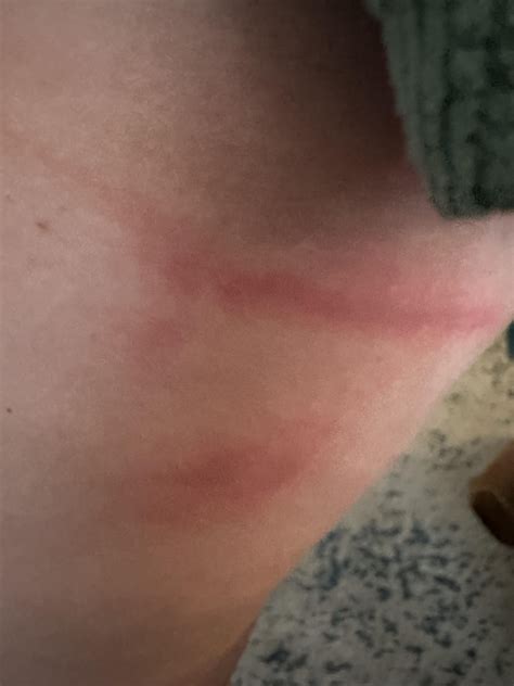 Weird rash after swimming in the ocean. : r/DermatologyQuestions