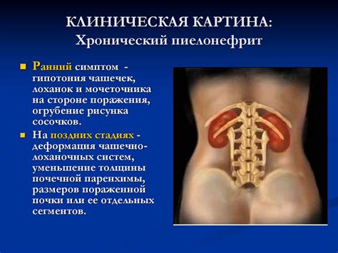 Пиелонефрит у детей - презентация онлайн