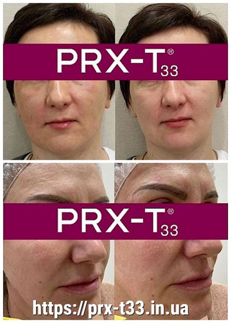 Пілінг PRX-T33 до і після - prx-t33.in.ua
