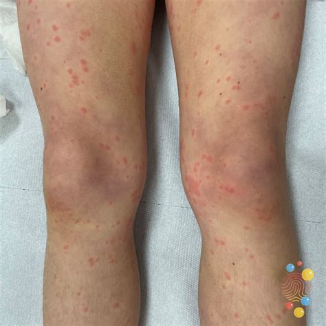 Henoch Schonlein Purpura Arthritis