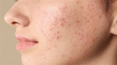 How To Remove Pimple Marks: Easy Home Remedies - HealthKart