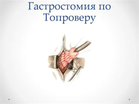 Гастростомия - презентация онлайн