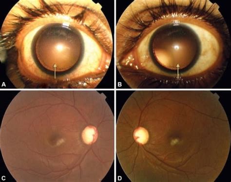 Marfan Syndrome Eyes