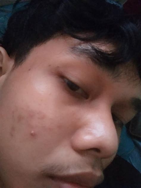 Help . What should I do suddenly cystic acne pop up when i recover from