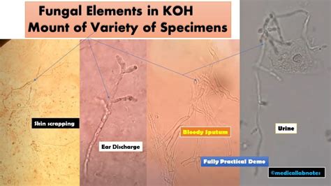 Procedure of KOH Wet Mount Preparation Archives - Medical Notes