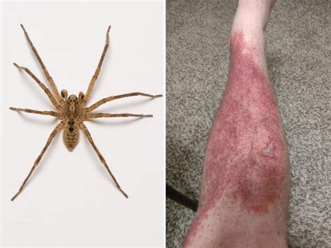 Brown Recluse Spider Bite First Stage