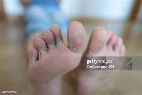 Tinea Pedis Photos and Premium High Res Pictures - Getty Images
