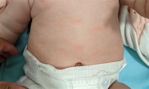 Allergic Reaction Rash Baby