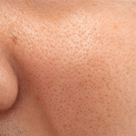 pores scars alpha asia aesthetics