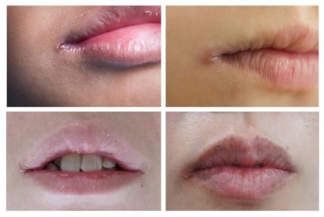 Angular Cheilitis: Causes, Symptoms, Treatment, and Prevention